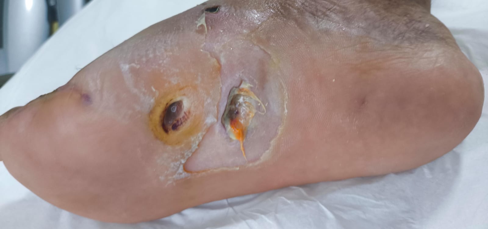 Foto depois do tratamento: Mal perfurante plantar em paciente diabético